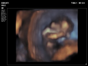 14 hetes embrió