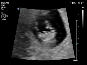 11 hetes fiú embrio