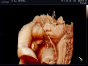 Iker terhesség(elválasztó burok, fej-far) (dr. Bata)