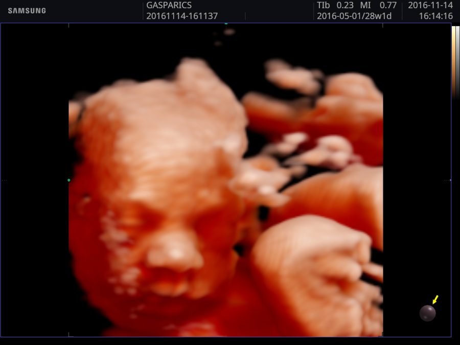 Hogyan tudok segíteni, hogy jó legyen a 4D- 5D ultrahang felvétel? (Mikor fogjuk jól látni a kisbabát?)
